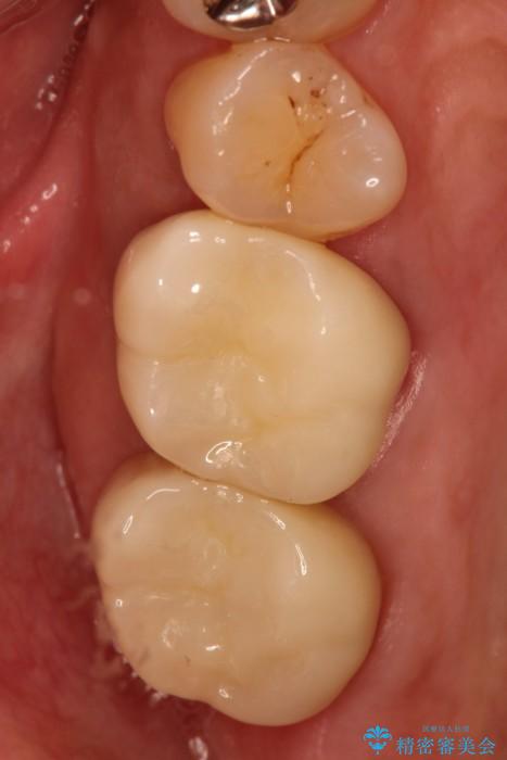 金属の下に虫歯　オールセラミッククラウンによる虫歯治療 治療後画像