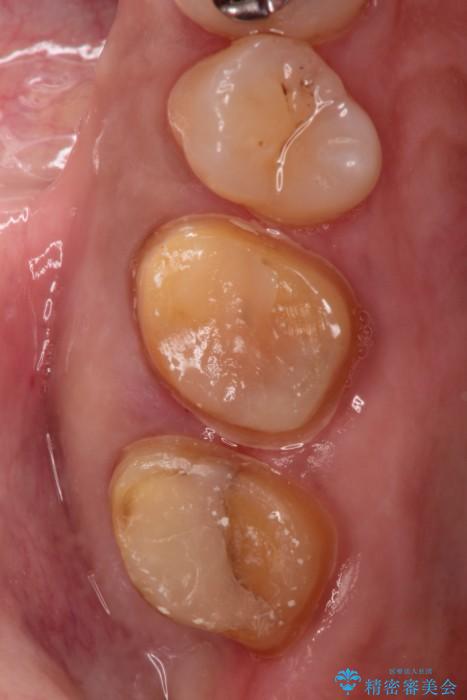 金属の下に虫歯　オールセラミッククラウンによる虫歯治療 治療途中画像