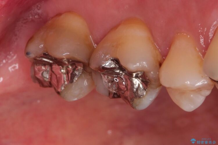 金属の下に虫歯　オールセラミッククラウンによる虫歯治療 治療前画像
