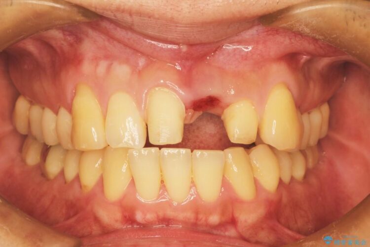前歯のブリッジ治療　部分矯正を併用して歯茎の形態をコントロール 治療後画像