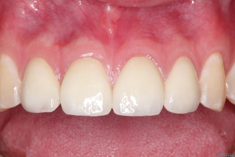 まだら色の前歯　セラミック治療による見た目の改善 治療後画像