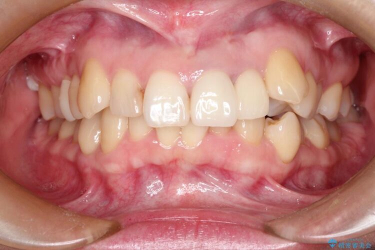 上の前歯に違和感がある　根管治療からの再治療 アフター