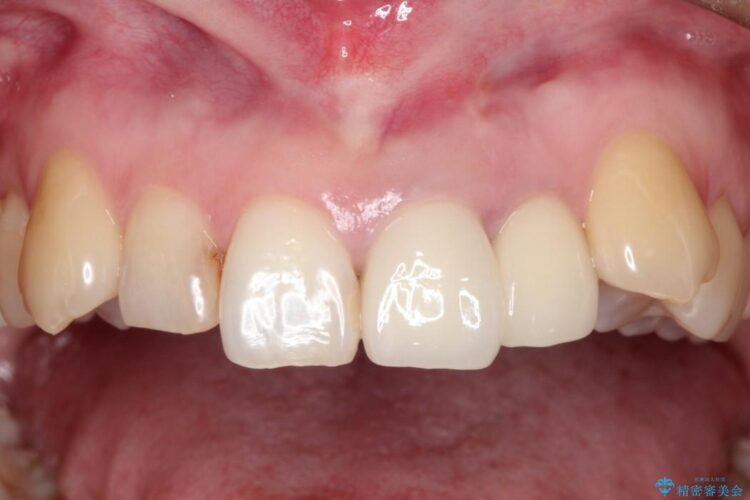 上の前歯に違和感がある　根管治療からの再治療 治療後画像