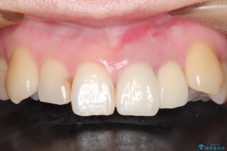 上の前歯に違和感がある　根管治療からの再治療 治療後画像
