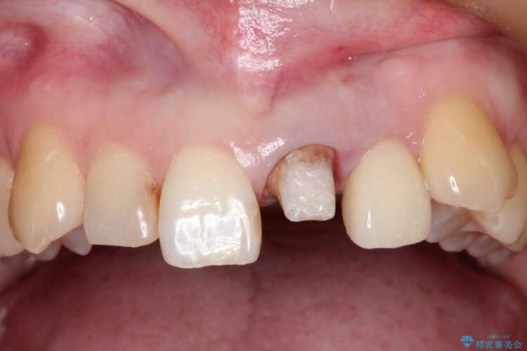 上の前歯に違和感がある　根管治療からの再治療 治療途中画像