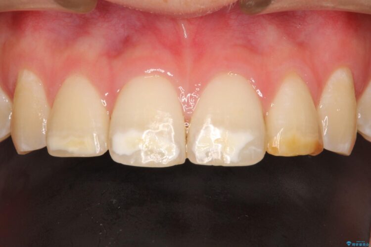 まだら色の前歯　セラミック治療による見た目の改善 治療前画像