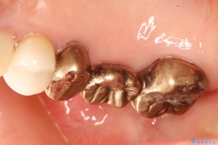 歯周外科の併用の補綴治療　適合の良いセラミックブリッジへ 治療前画像