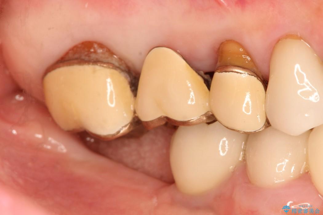 歯周外科の併用の補綴治療　適合の良いセラミックブリッジへ 治療前