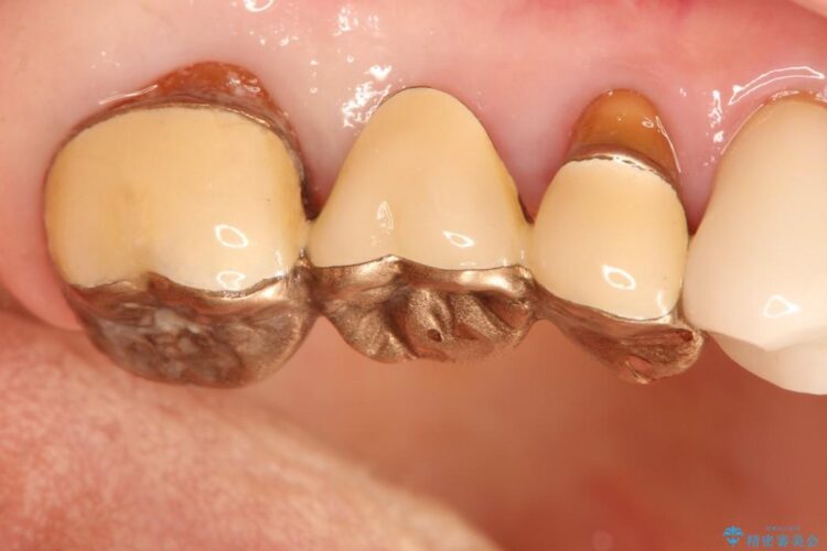歯周外科の併用の補綴治療　適合の良いセラミックブリッジへ 治療前画像