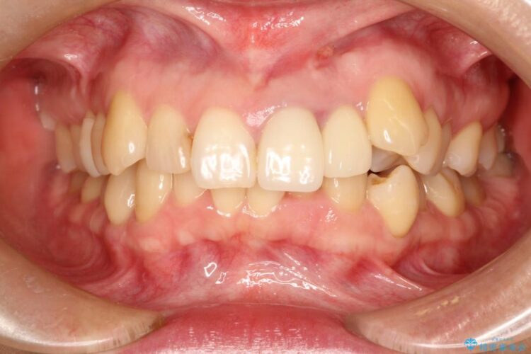 上の前歯に違和感がある　根管治療からの再治療 治療前画像