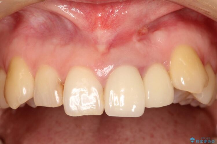 上の前歯に違和感がある　根管治療からの再治療 治療前画像