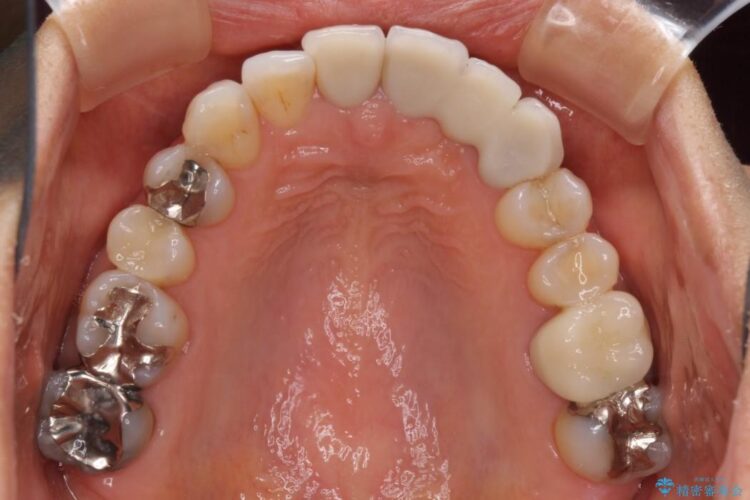 目立つ銀歯を白くしたい　銀歯からセラミックへの再補綴 治療後画像