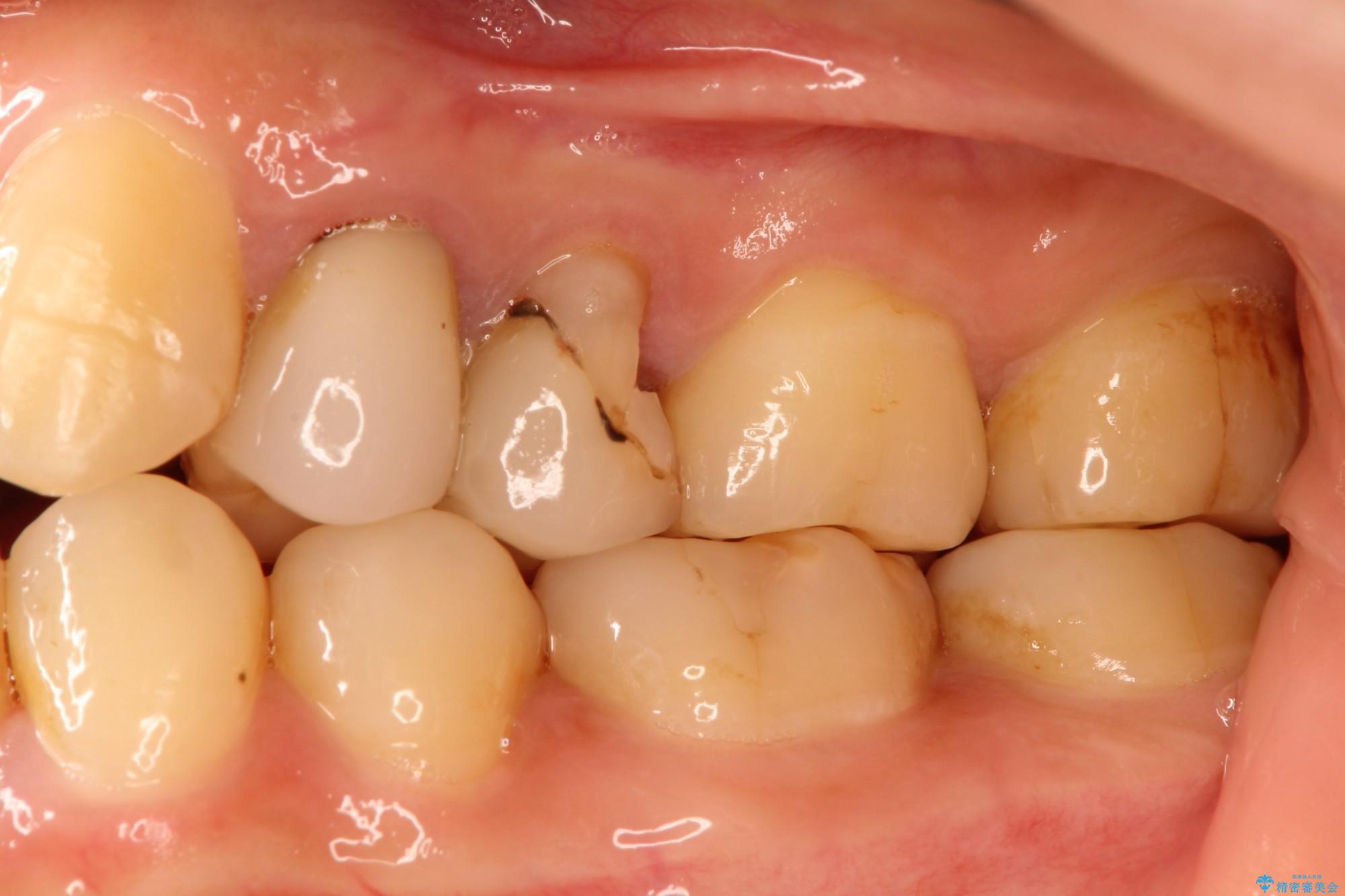 歯肉の中までの深い虫歯　部分矯正後のセラミック治療 治療前