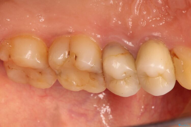 歯肉の中までの深い虫歯　部分矯正後のセラミック治療 治療前画像