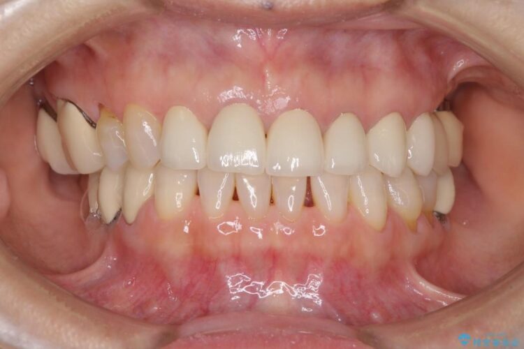 歯の根元が黒いのが気になる　セラミックによる再補綴での改善 アフター