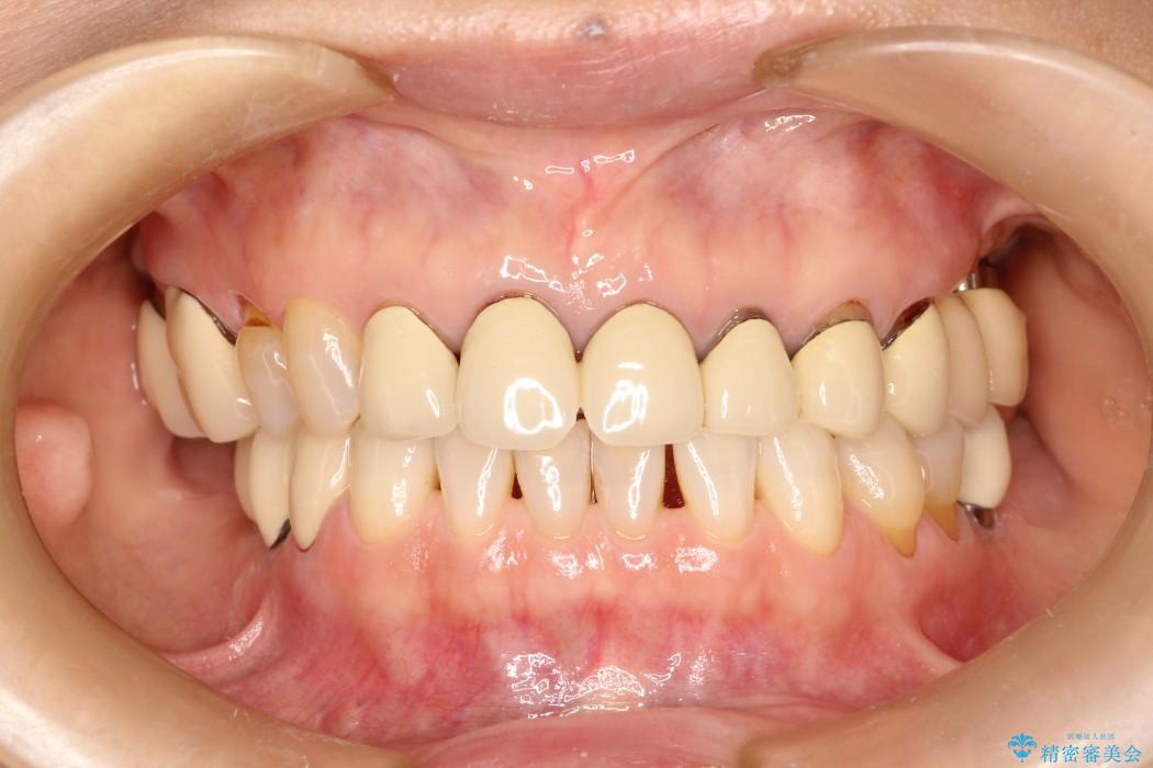 歯の根元が黒いのが気になる　セラミックによる再補綴での改善 治療前