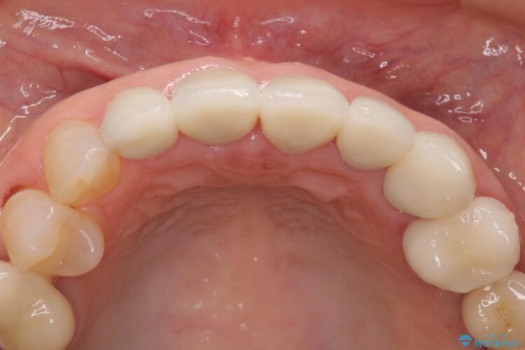 歯の根元が黒いのが気になる　セラミックによる再補綴での改善 治療後画像