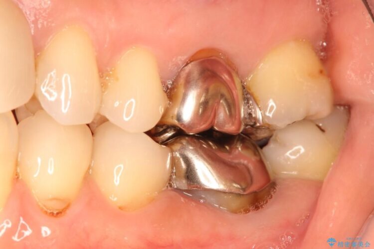 目立つ銀歯を白くしたい　銀歯からセラミックへの再補綴 治療前画像