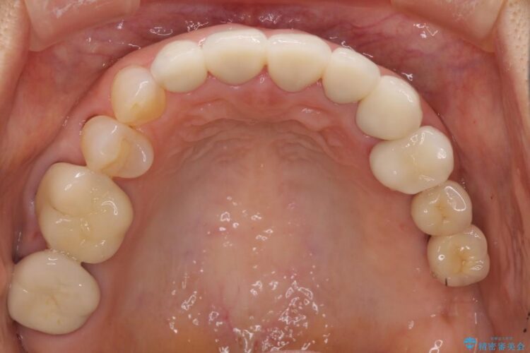 歯の根元が黒いのが気になる　セラミックによる再補綴での改善 治療後画像
