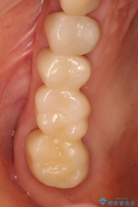 歯周外科の併用の補綴治療　適合の良いセラミックブリッジへ 治療後画像