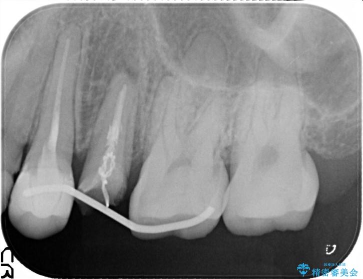 歯肉の中までの深い虫歯　部分矯正後のセラミック治療 治療後画像