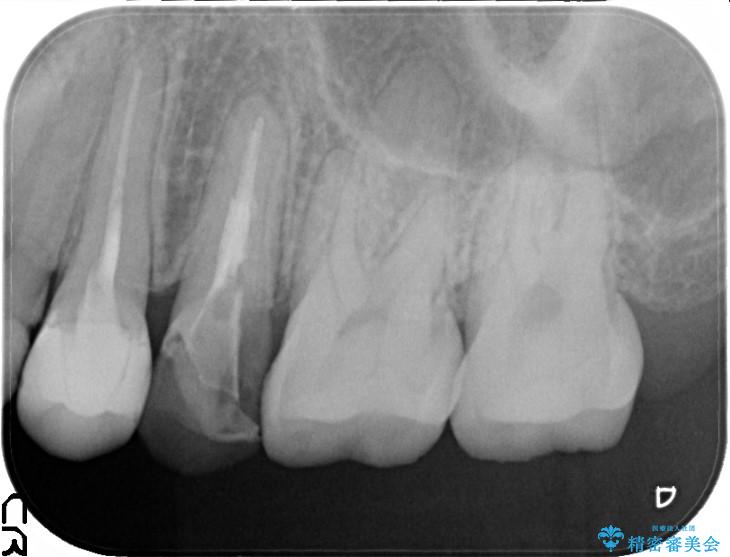 歯肉の中までの深い虫歯　部分矯正後のセラミック治療 治療前画像
