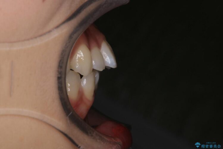 インビザラインで前歯の並びを改善 治療前画像