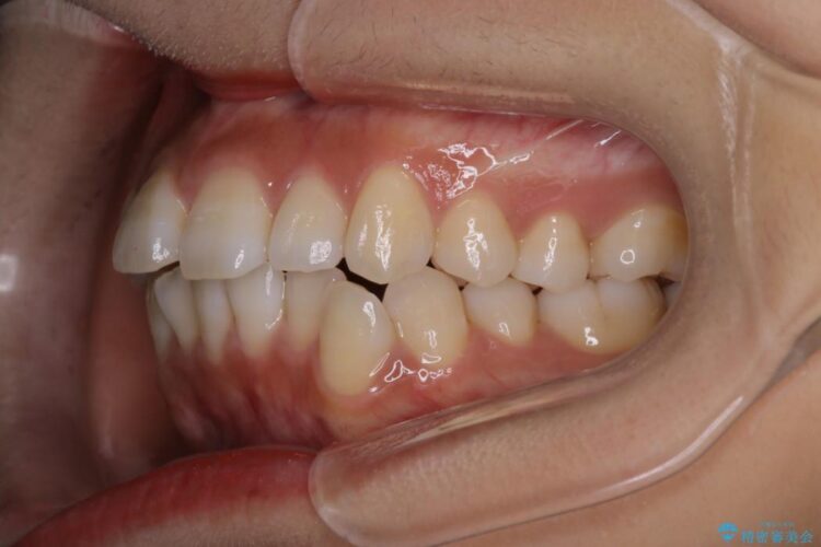 インビザラインで前歯の並びを改善 治療前画像