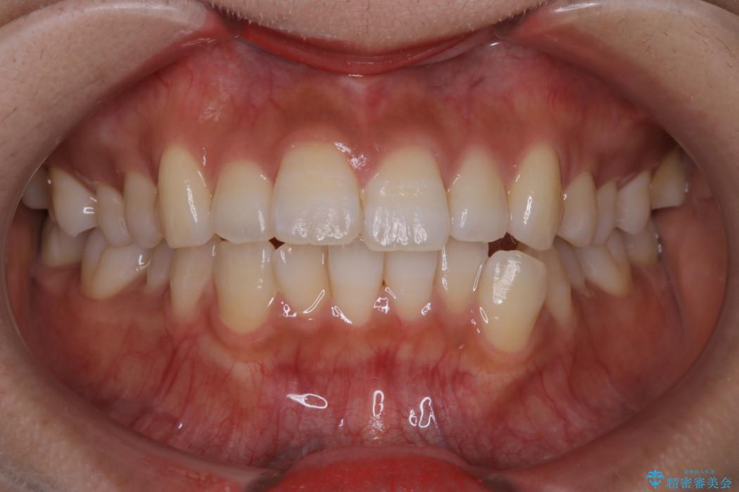 インビザラインで前歯の並びを改善 治療前
