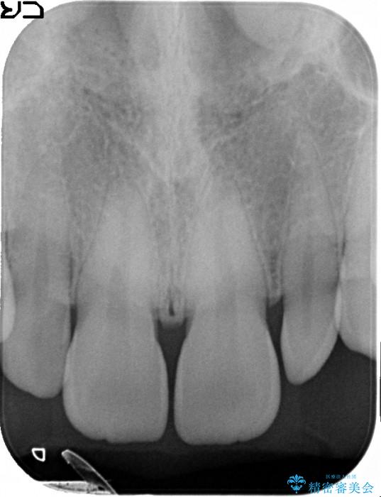 正中のすき間の部分矯正・矮小歯のオールセラミックによる治療 治療前画像