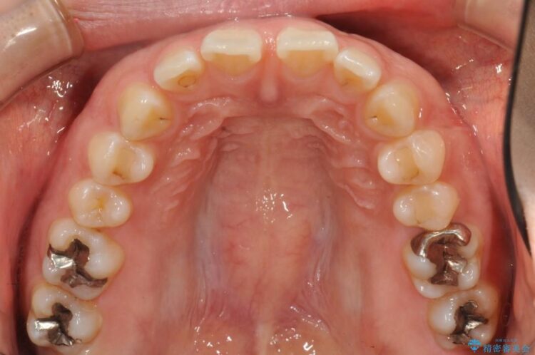 すきっ歯　ワイヤー矯正による治療 治療前画像