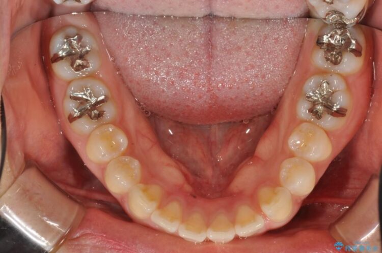 すきっ歯　ワイヤー矯正による治療 治療前画像