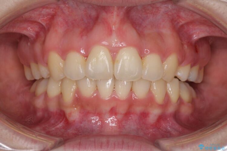 重度の前歯のガタガタ　ワイヤーによる矯正治療 アフター