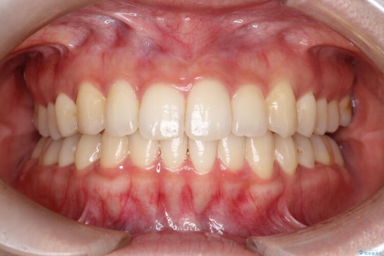 前歯のがたがた気になる　目立たないインビザラインによる矯正治療 アフター