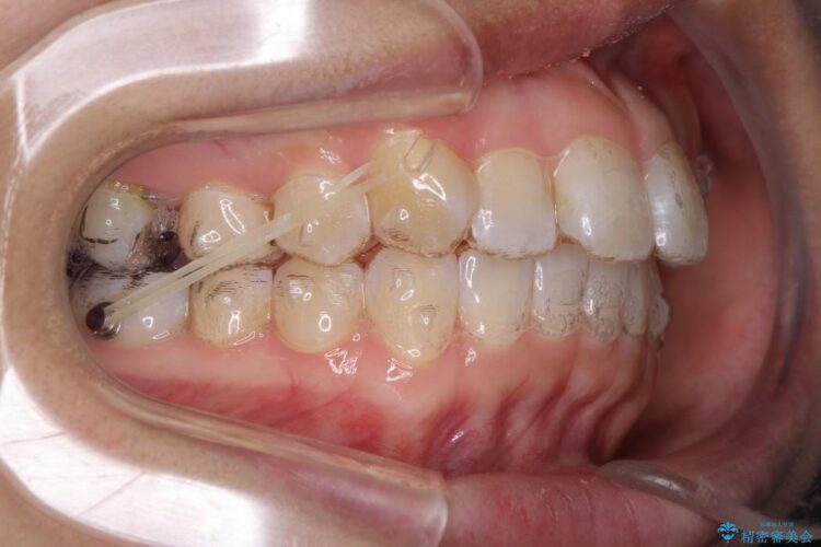 インビザラインで目立たず・歯を抜かずに八重歯の矯正 治療途中画像