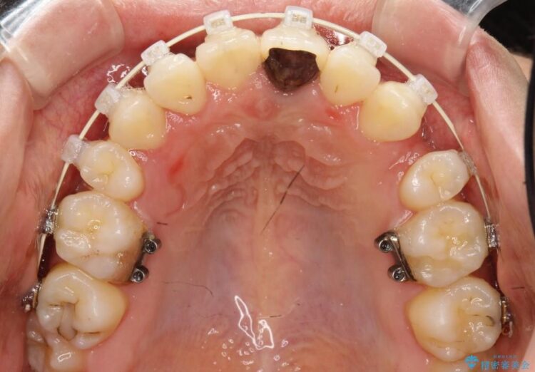 20代女性のワイヤー装置による八重歯の矯正治療 治療途中画像