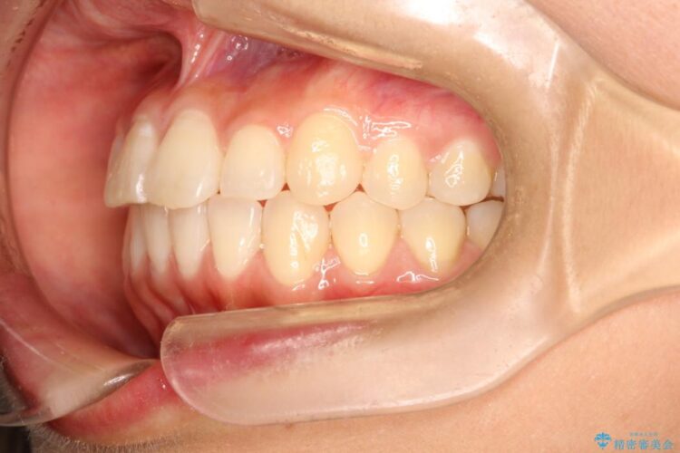 インビザラインで前歯のデコボコを目立たず矯正 治療後画像