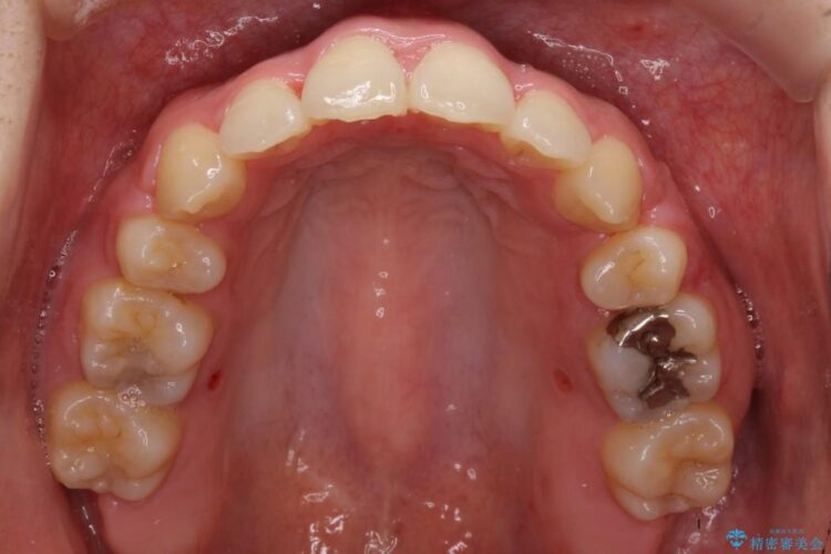 重度の前歯のガタガタ　ワイヤーによる矯正治療 治療後画像
