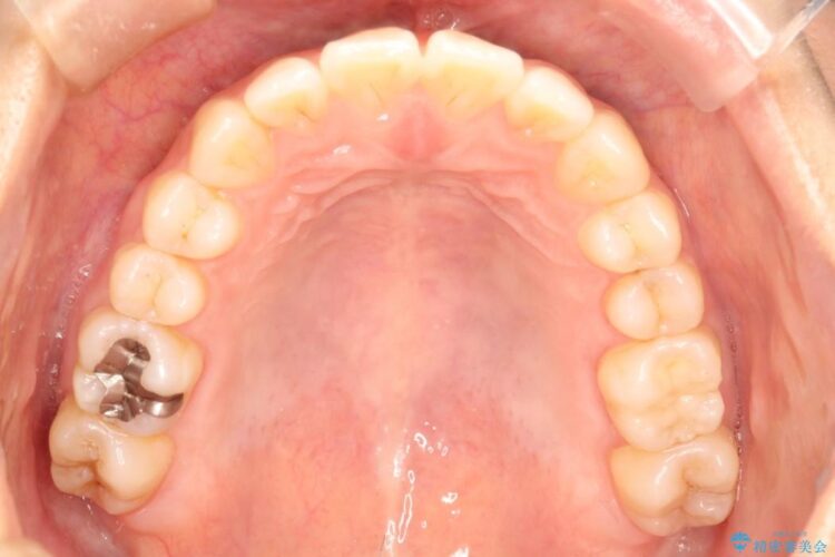 インビザラインで前歯のデコボコを目立たず矯正 治療後画像