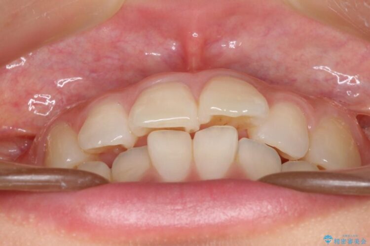 インビザラインで前歯のデコボコを目立たず矯正 治療前画像