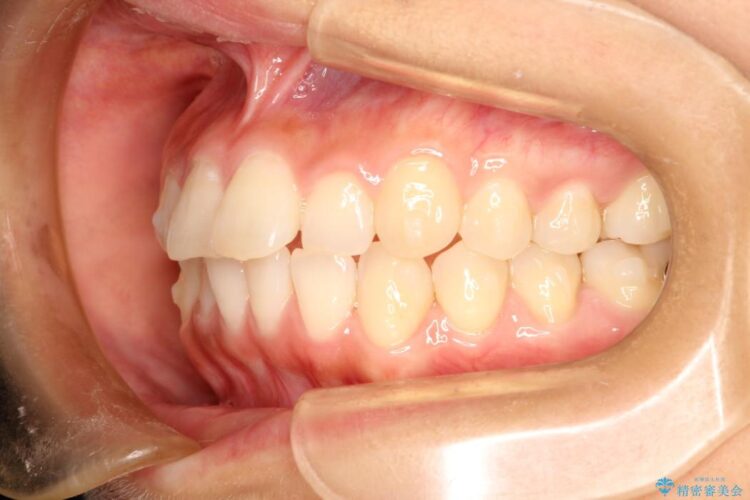 インビザラインで前歯のデコボコを目立たず矯正 治療途中画像