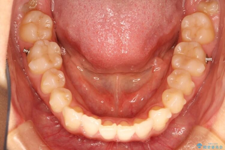 インビザラインで前歯のデコボコを目立たず矯正 治療途中画像