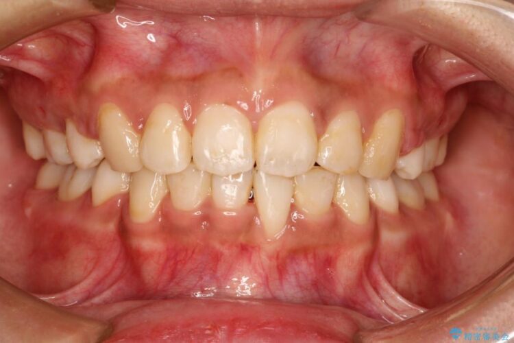 前歯のガタガタ・八重歯治したい　ワイヤーによる矯正 治療後画像