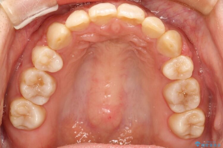 前歯のガタガタ・八重歯治したい　ワイヤーによる矯正 治療後画像