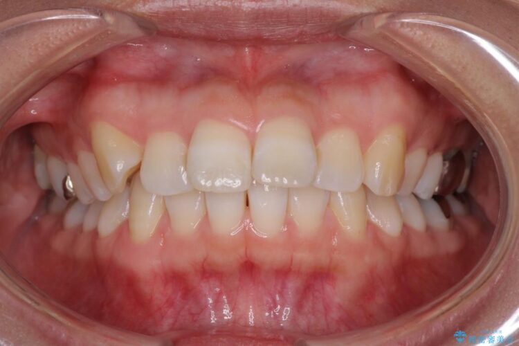 インビザラインで目立たず・歯を抜かずに八重歯の矯正 治療前画像