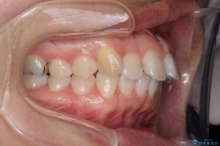 インビザラインで目立たず・歯を抜かずに八重歯の矯正 治療前画像