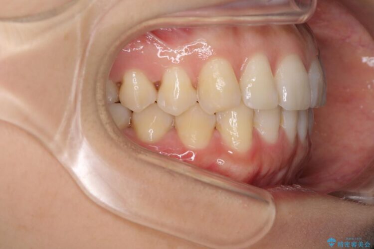 インビザラインで周りに知られず歯の矯正を 治療後画像