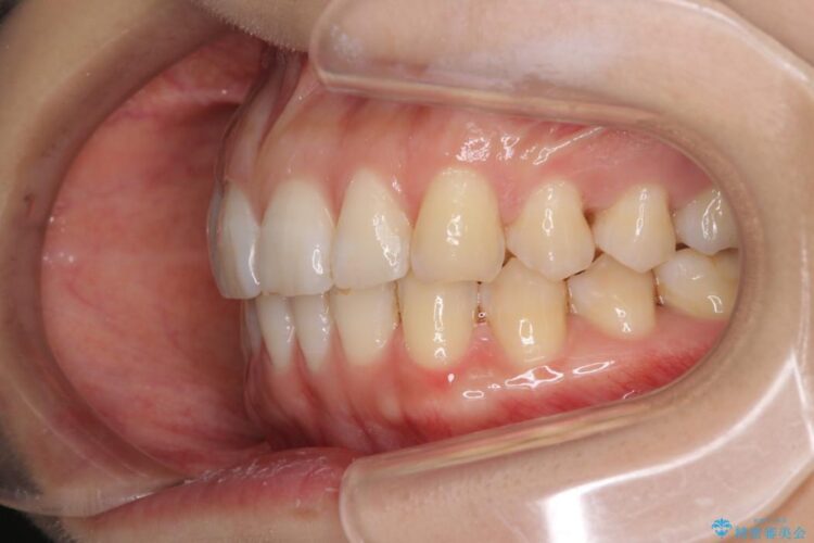インビザラインで周りに知られず歯の矯正を 治療後画像