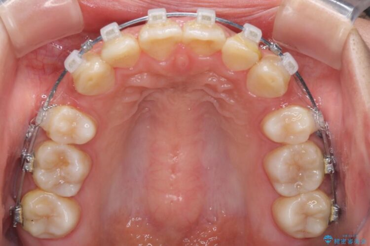 前歯のガタガタ・八重歯治したい　ワイヤーによる矯正 治療途中画像