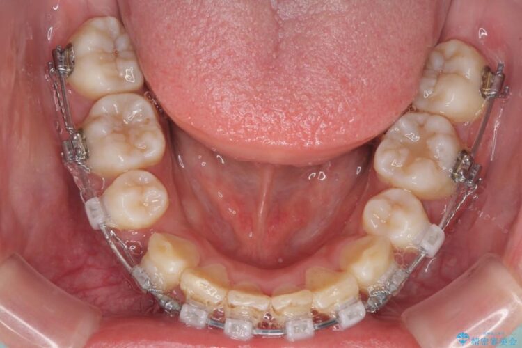 前歯のガタガタ・八重歯治したい　ワイヤーによる矯正 治療途中画像